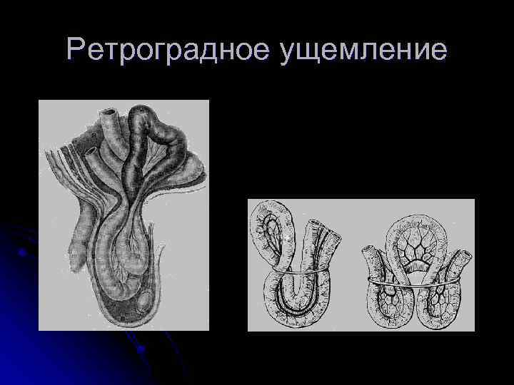 Ретроградное ущемление 