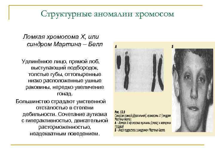 Структурные аномалии хромосом Ломкая хромосома Х, или синдром Мартина – Белл Удлинённое лицо, прямой