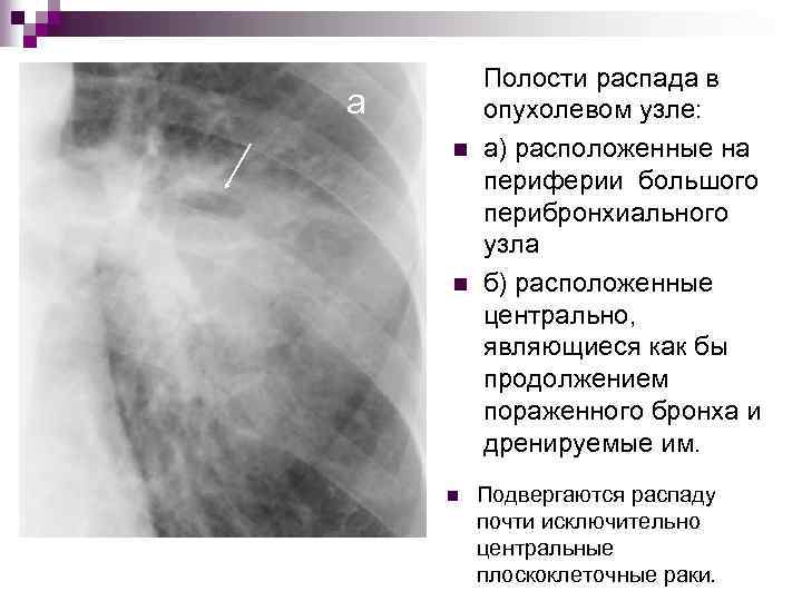 а n n n Полости распада в опухолевом узле: а) расположенные на периферии большого