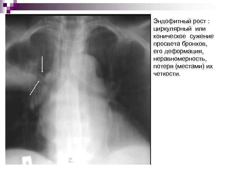 Эндофитный рост : циркулярный или коническое сужение просвета бронхов, его деформация, неравномерность, потеря (местами)