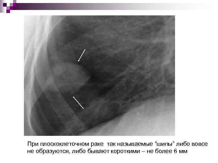 При плоскоклеточном раке так называемые “шипы” либо вовсе не образуются, либо бывают короткими –