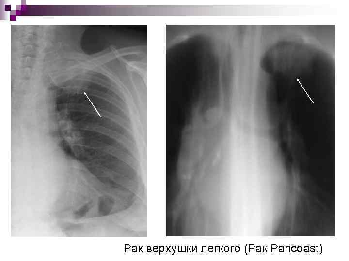 Рак верхушки легкого (Рак Pancoast) 