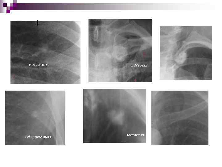 1 2 гамартома 3 остеома 4 туберкуломы метастаз 