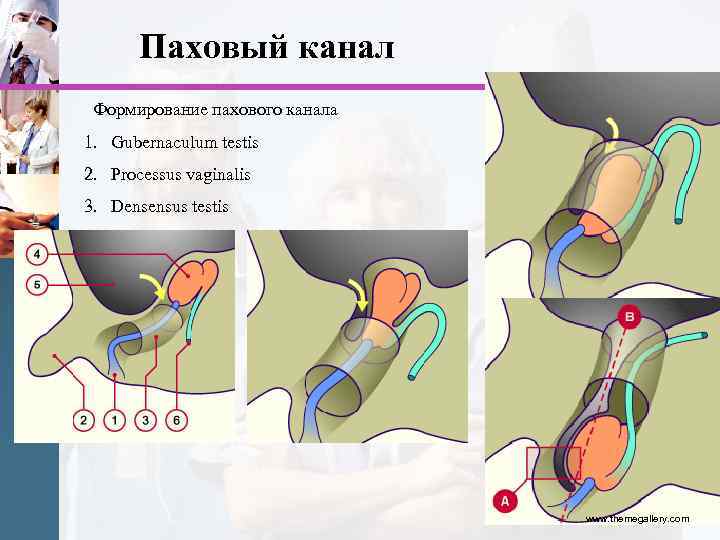 Паховый канал Формирование пахового канала 1. Gubernaculum testis 2. Processus vaginalis 3. Densensus testis