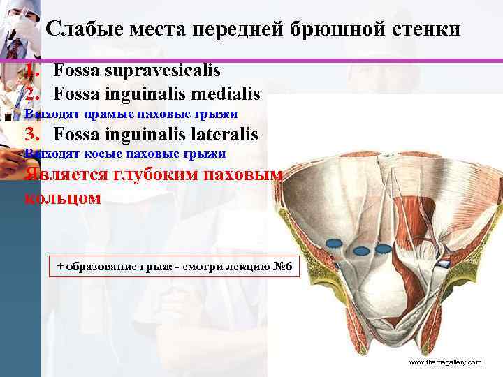 Слабые места передней брюшной стенки 1. Fossa supravesicalis 2. Fossa inguinalis medialis Выходят прямые