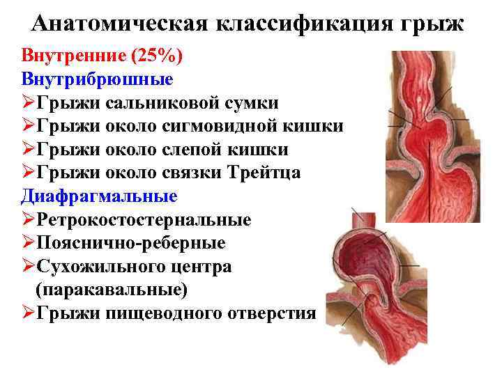 Анатомическая классификация грыж Внутренние (25%) Внутрибрюшные ØГрыжи сальниковой сумки ØГрыжи около сигмовидной кишки ØГрыжи