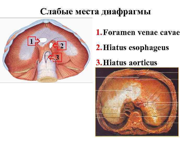 Слабые места диафрагмы 1. Foramen venae cavae 1 2 3 2. Hiatus esophageus 3.