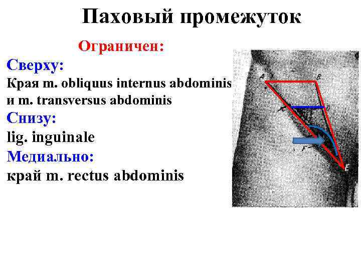 Паховый промежуток Ограничен: Сверху: Края m. obliquus internus abdominis и m. transversus abdominis Снизу: