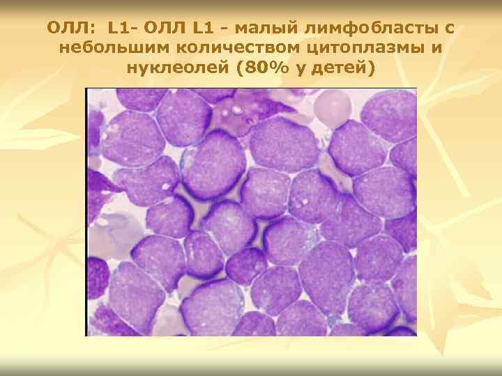 ОЛЛ: L 1 - ОЛЛ L 1 - малый лимфобласты с небольшим количеством цитоплазмы