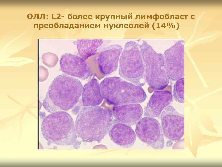 ОЛЛ: L 2 - более крупный лимфобласт с преобладанием нуклеолей (14%) 