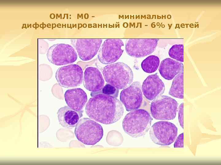 ОМЛ: М 0 минимально дифференцированный ОМЛ - 6% у детей 