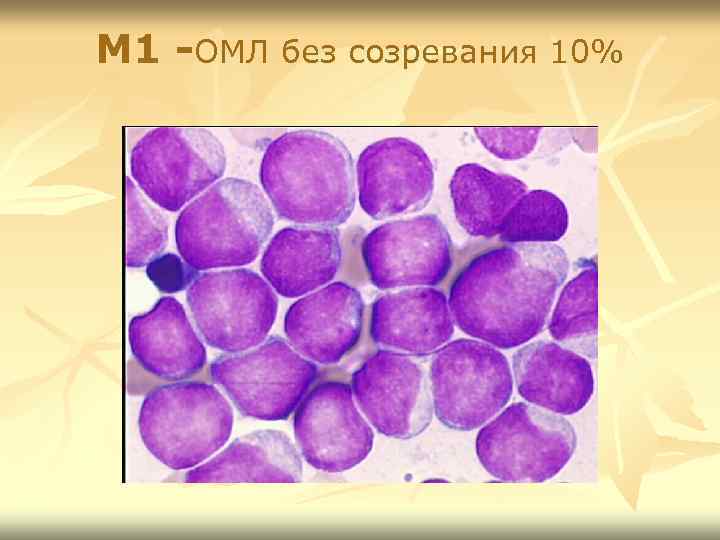 М 1 -ОМЛ без созревания 10% 