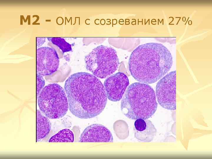 М 2 - ОМЛ с созреванием 27% 