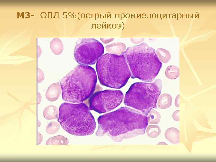 М 3 - ОПЛ 5%(острый промиелоцитарный лейкоз) 