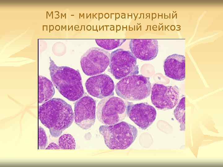 М 3 м - микрогранулярный промиелоцитарный лейкоз 