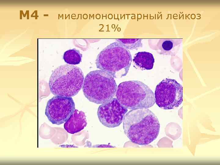 М 4 - миеломоноцитарный лейкоз 21% 