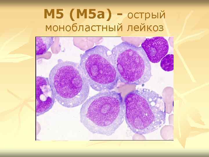 М 5 (М 5 а) - острый монобластный лейкоз 