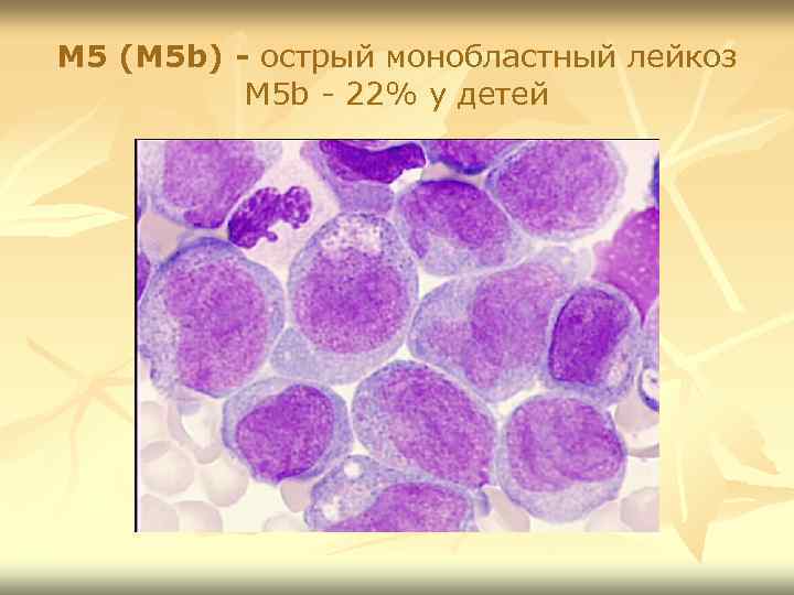 М 5 (М 5 b) - острый монобластный лейкоз М 5 b - 22%