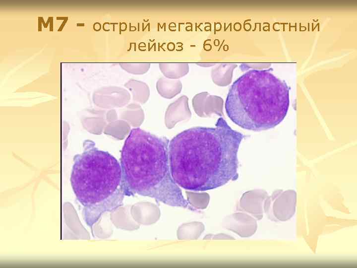 M 7 - острый мегакариобластный лейкоз - 6% 