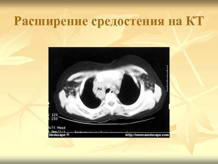 Расширение средостения на КТ 