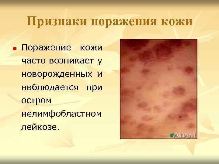 Признаки поражения кожи n Поражение кожи часто возникает у новорожденных и нвблюдается при остром