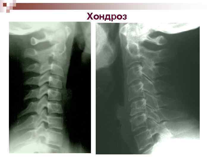 Хондроз 