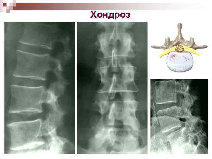 Хондроз 