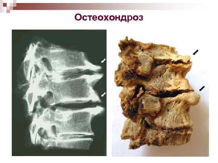 Остеохондроз 