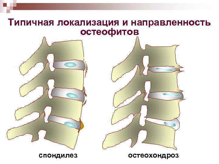 Типичная локализация и направленность остеофитов спондилез остеохондроз 