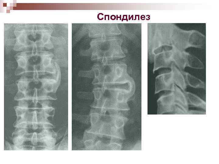 Спондилез 