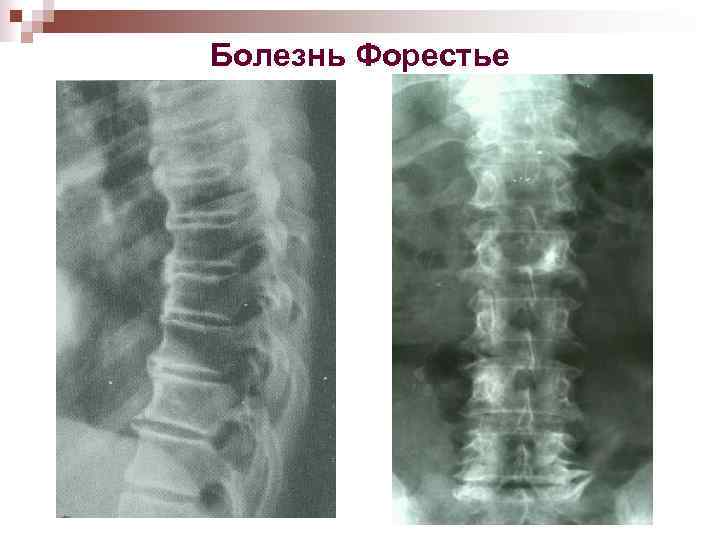 Болезнь Форестье 