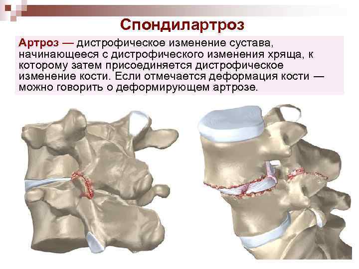 Спондилартроз Артроз — дистрофическое изменение сустава, начинающееся с дистрофического изменения хряща, к которому затем
