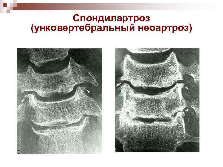 Спондилартроз (унковертебральный неоартроз) 