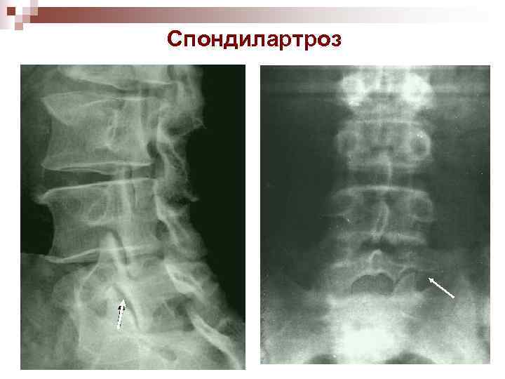 Спондилартроз 