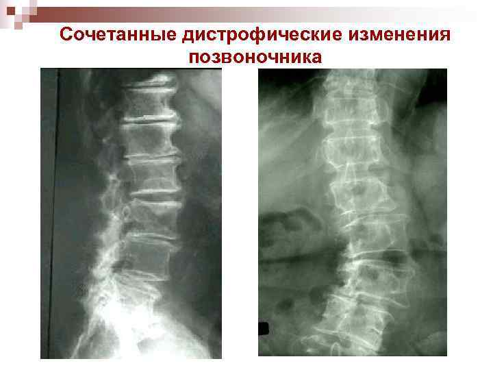 Сочетанные дистрофические изменения позвоночника 