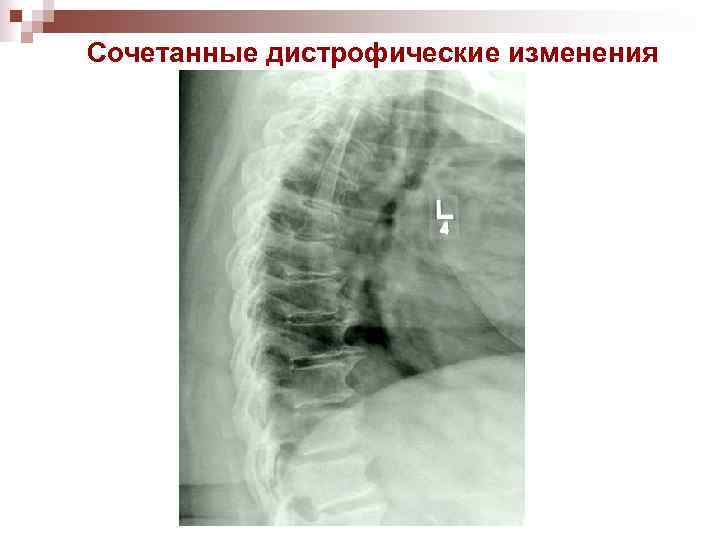Сочетанные дистрофические изменения 