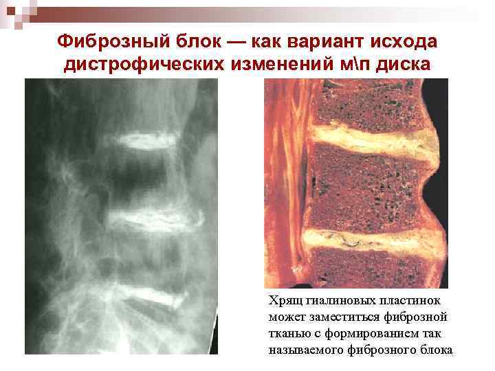 Фиброзный блок — как вариант исхода дистрофических изменений мп диска Хрящ гиалиновых пластинок может