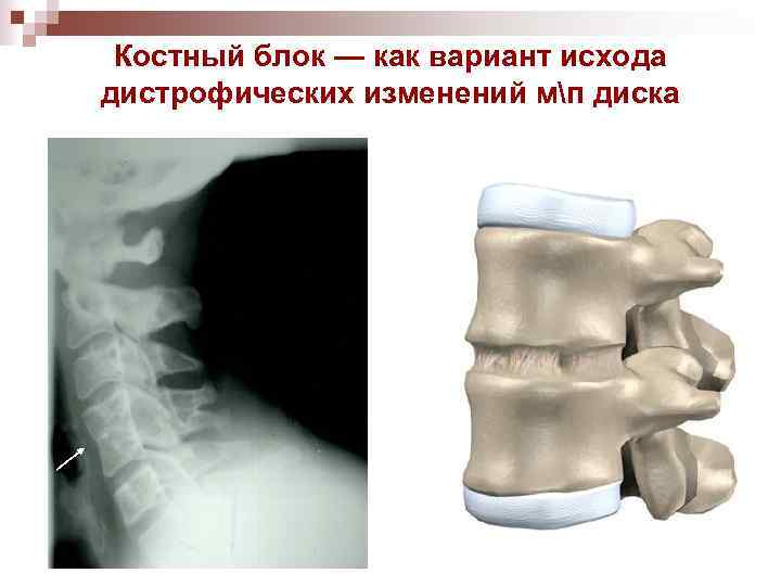 Костный блок — как вариант исхода дистрофических изменений мп диска 