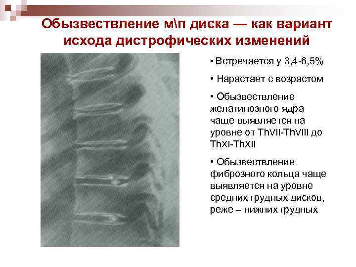 Обызвествление мп диска — как вариант исхода дистрофических изменений • Встречается у 3, 4