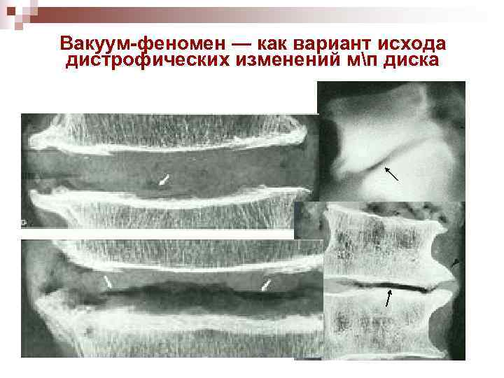 Вакуум-феномен — как вариант исхода дистрофических изменений мп диска 