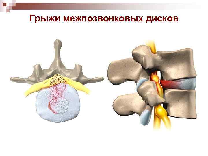 Грыжи межпозвонковых дисков 