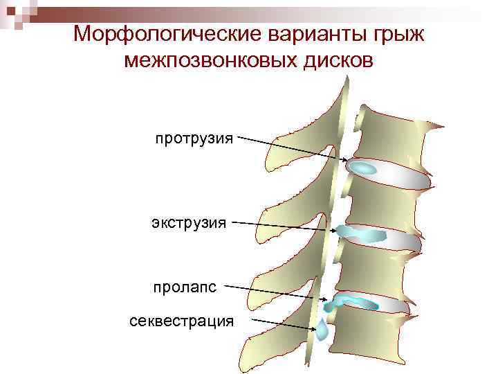 Морфологические варианты грыж межпозвонковых дисков протрузия экструзия пролапс секвестрация 
