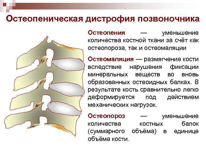 Остеопеническая дистрофия позвоночника Остеопения — уменьшение количества костной ткани за счёт как остеопороза, так