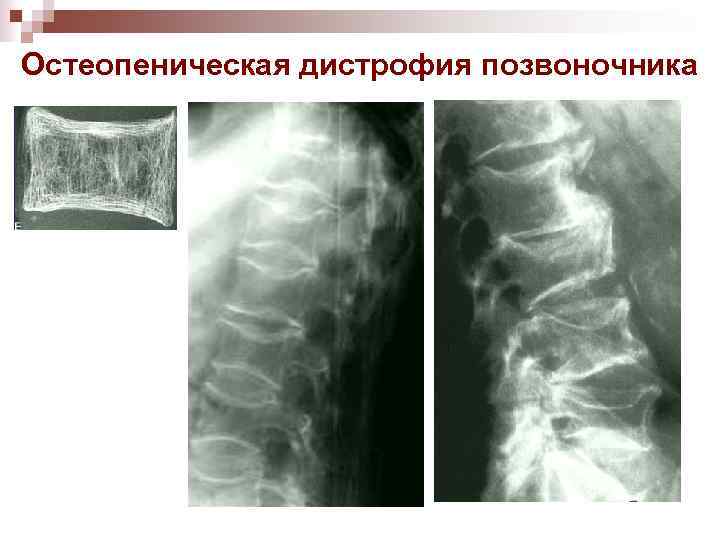 Остеопеническая дистрофия позвоночника 
