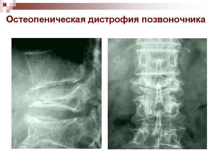 Остеопеническая дистрофия позвоночника 