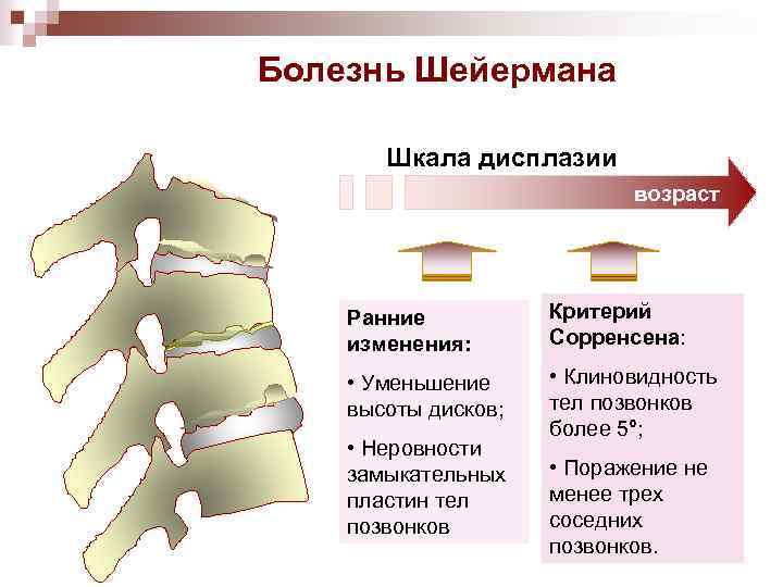 Болезнь Шейермана Шкала дисплазии возраст Ранние изменения: Критерий Сорренсена: • Уменьшение высоты дисков; •