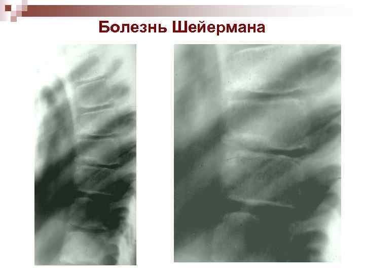 Болезнь Шейермана 