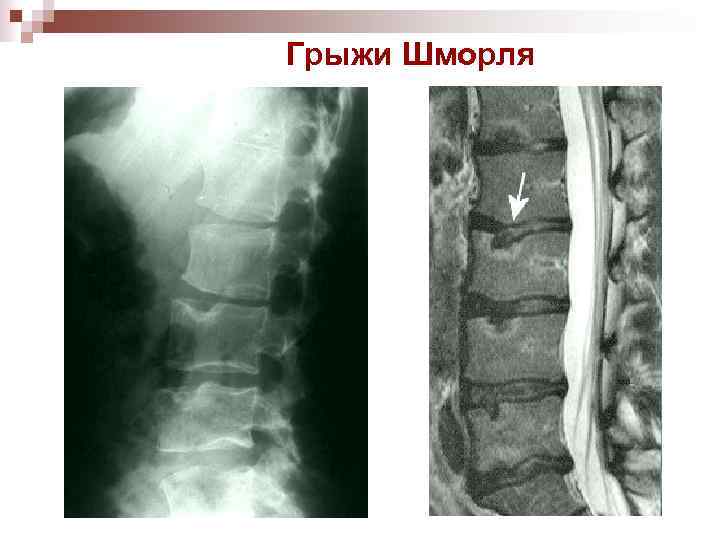 Грыжи Шморля 