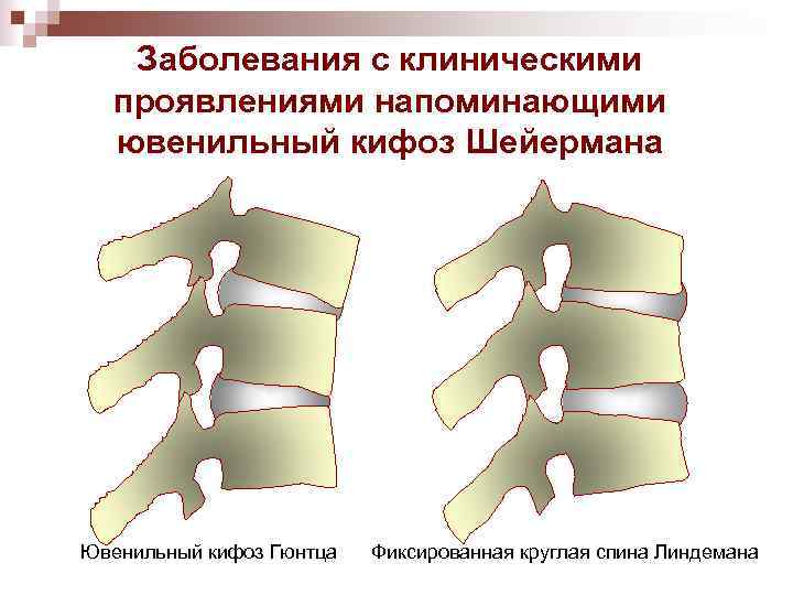 Заболевания с клиническими проявлениями напоминающими ювенильный кифоз Шейермана Ювенильный кифоз Гюнтца Фиксированная круглая спина