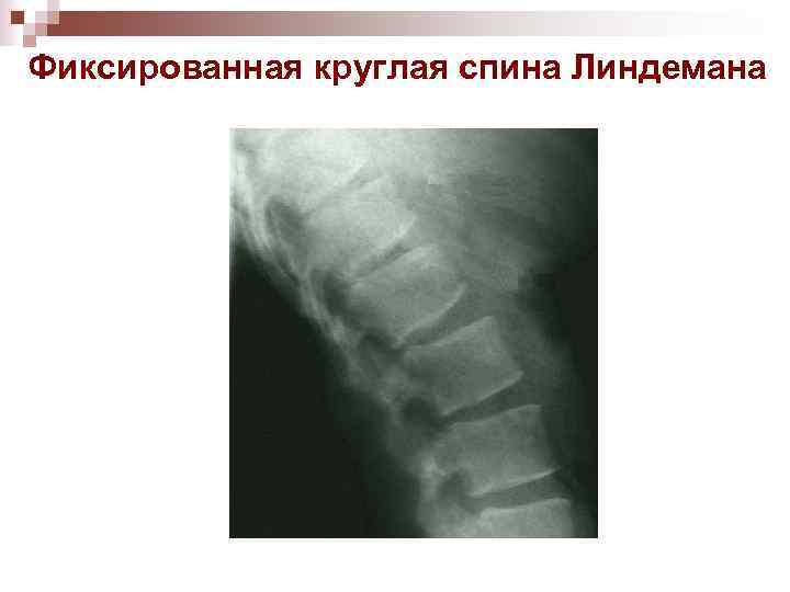 Фиксированная круглая спина Линдемана 